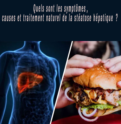 Quels sont les symptômes, causes et traitement naturel de la stéatose hépatique ?