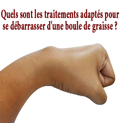 Quels sont les traitements adaptés pour se débarrasser d'une boule de graisse ? Quels sont les traitements adaptés pour se débarrasser d'une boule de graisse ?