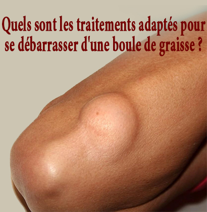 Quels sont les traitements adaptés pour se débarrasser d'une boule de graisse ? Quels sont les traitements adaptés pour se débarrasser d'une boule de graisse ?