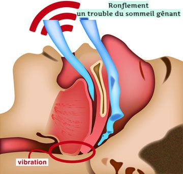 Ronflement, un trouble du sommeil gênant !