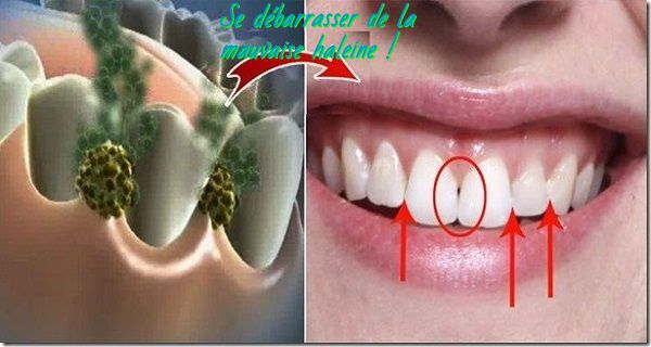 comment se débarrasser de la mauvaise haleine Se débarrasser de la mauvaise haleine !