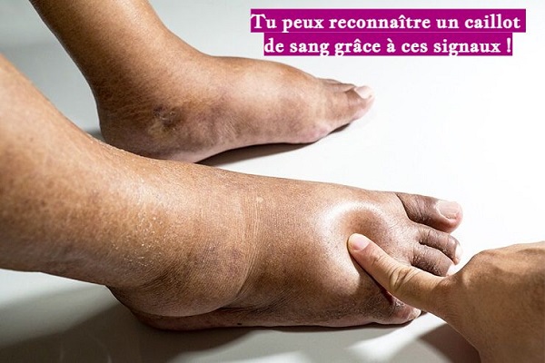 Tu peux reconnaître un caillot de sang grâce à ces signaux !