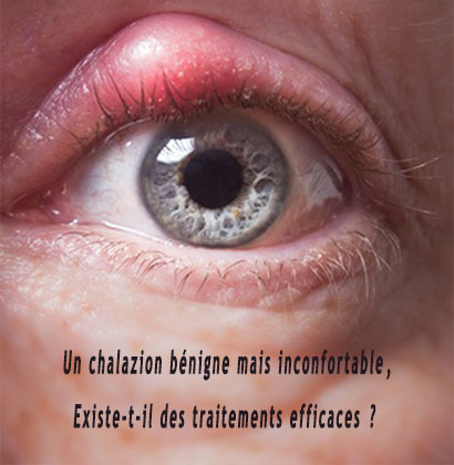 Un chalazion bénigne mais inconfortable, Existe-t-il des traitements efficaces ? 