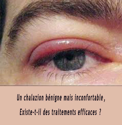 Un chalazion bénigne mais inconfortable, Existe-t-il des traitements efficaces ? Un chalazion bénigne mais inconfortable, Existe-t-il des traitements efficaces ?