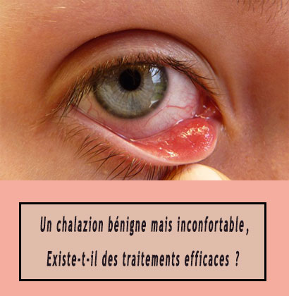 Un chalazion bénigne mais inconfortable, Existe-t-il des traitements efficaces ? Un chalazion bénigne mais inconfortable, Existe-t-il des traitements efficaces ?