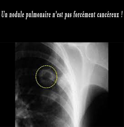 Un nodule pulmonaire n'est pas forcément cancéreux ! Un nodule pulmonaire n'est pas forcément cancéreux !