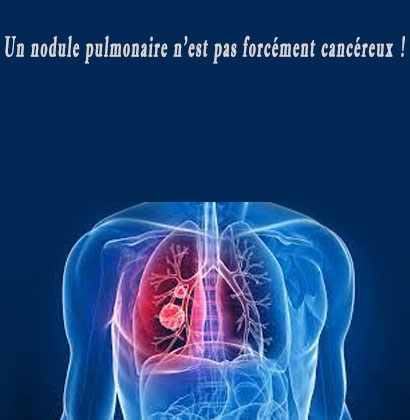 Un nodule pulmonaire n'est pas forcément cancéreux ! Un nodule pulmonaire n'est pas forcément cancéreux !