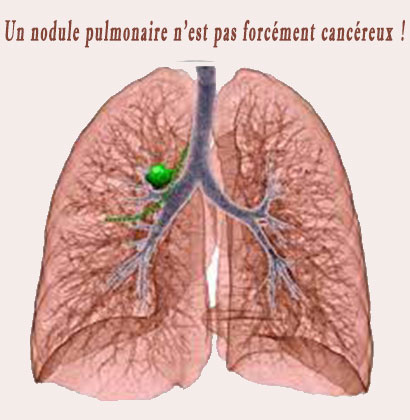 Un nodule pulmonaire n'est pas forcément cancéreux ! Un nodule pulmonaire n'est pas forcément cancéreux !