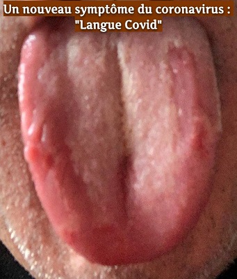 Un nouveau symptôme du coronavirus : Un nouveau symptôme du coronavirus : "Langue Covid"