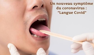 Un nouveau symptôme du coronavirus : "Langue Covid"