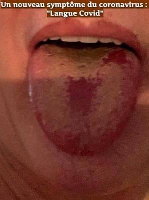Un nouveau symptôme du coronavirus : Un nouveau symptôme du coronavirus : "Langue Covid"
