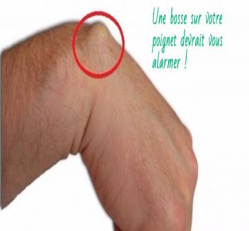 Généralement, si vous voyez une bosse sur votre main ou vos doigts, vous penserez probablement qu'il s'agit d'un gonflement causé par un choc