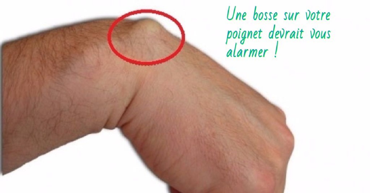 Pouce Qui Tremble Quand Je Le Plie Une bosse sur votre poignet devrait vous alarmer