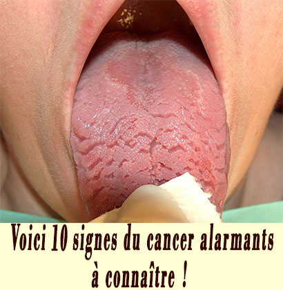 Voici 10 signes du cancer alarmants à connaître !