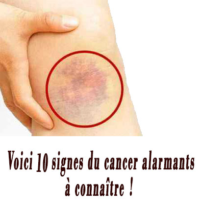 Voici 10 signes du cancer alarmants à connaître !