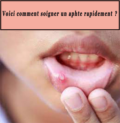 Voici comment soigner un aphte rapidement ?