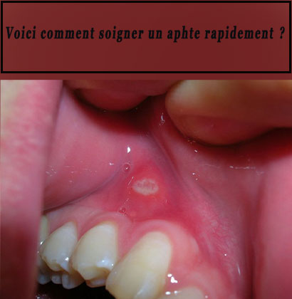 Voici comment soigner un aphte rapidement ?