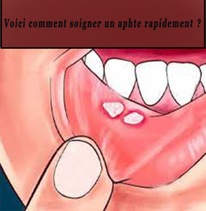 Voici comment soigner un aphte rapidement ?