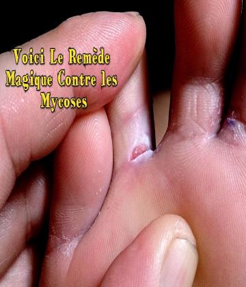 Les mycoses sont causées par de microscopiques champignons.  il existe un remède très efficace pour soigner les démangeaisons d'une mycose.  