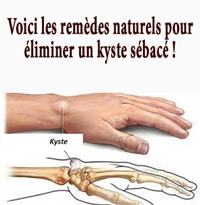 Voici les remèdes naturels pour éliminer un kyste sébacé !