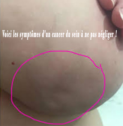 Voici les symptômes d'un cancer du sein à ne pas négliger !