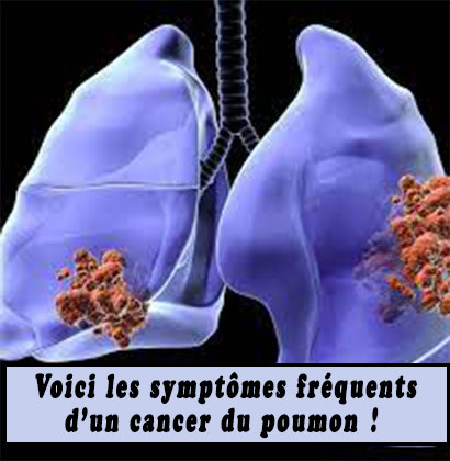 Voici les symptômes fréquents d’un cancer du poumon ! Voici les symptômes fréquents d’un cancer du poumon !