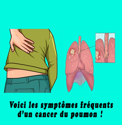Voici les symptômes fréquents d’un cancer du poumon ! Voici les symptômes fréquents d’un cancer du poumon !