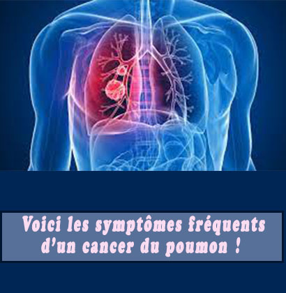 Voici les symptômes fréquents d’un cancer du poumon ! Voici les symptômes fréquents d’un cancer du poumon !