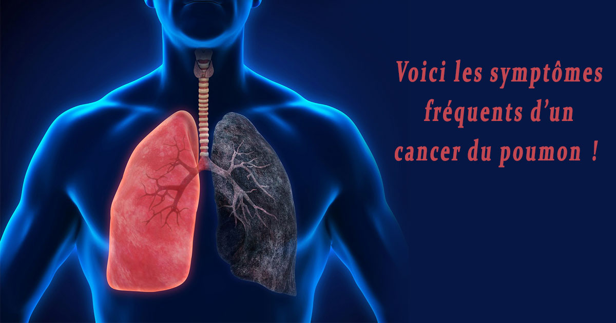 Voici les symptômes fréquents d’un cancer du poumon — free download