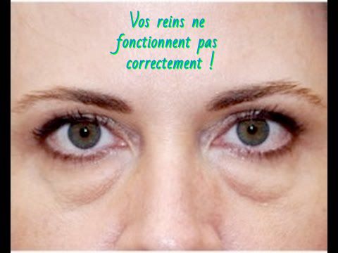 Les poches autour des yeux Vos reins ne fonctionnent pas correctement