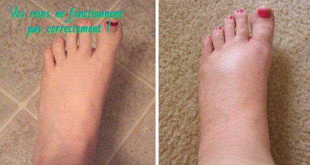Le gonflement des pieds et des mains Vos reins ne fonctionnent pas correctement
