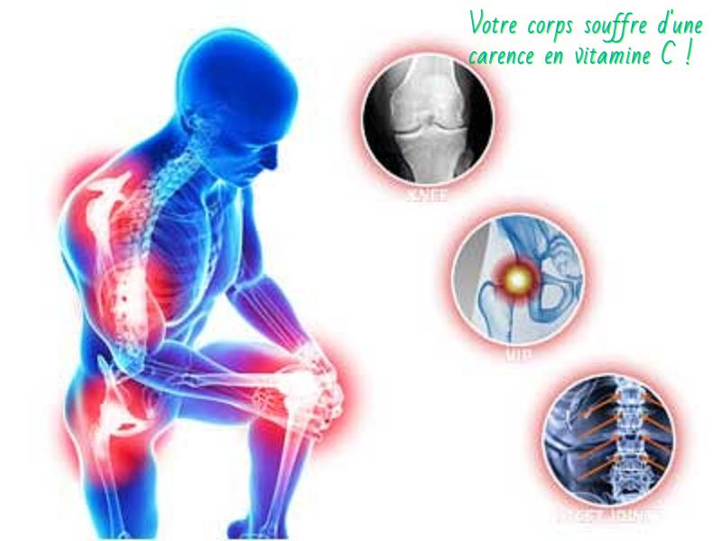 Votre corps souffre d'une carence en vitamine C Votre corps souffre d'une carence en vitamine C