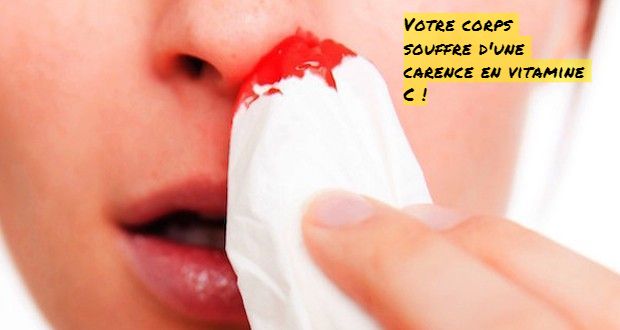 Le saignement du Nez Votre corps souffre d'une carence en vitamine C