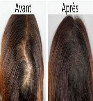 Chute de cheveux Comment arrêter la chute de cheveux définitivement ?