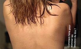 Comment faire pour éliminer les boutons du dos ?