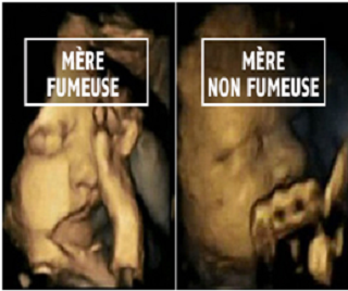 La femme enceinte et le tabagisme.