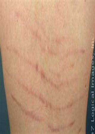 Le blanchiment de la peau peut vous défigurer !
