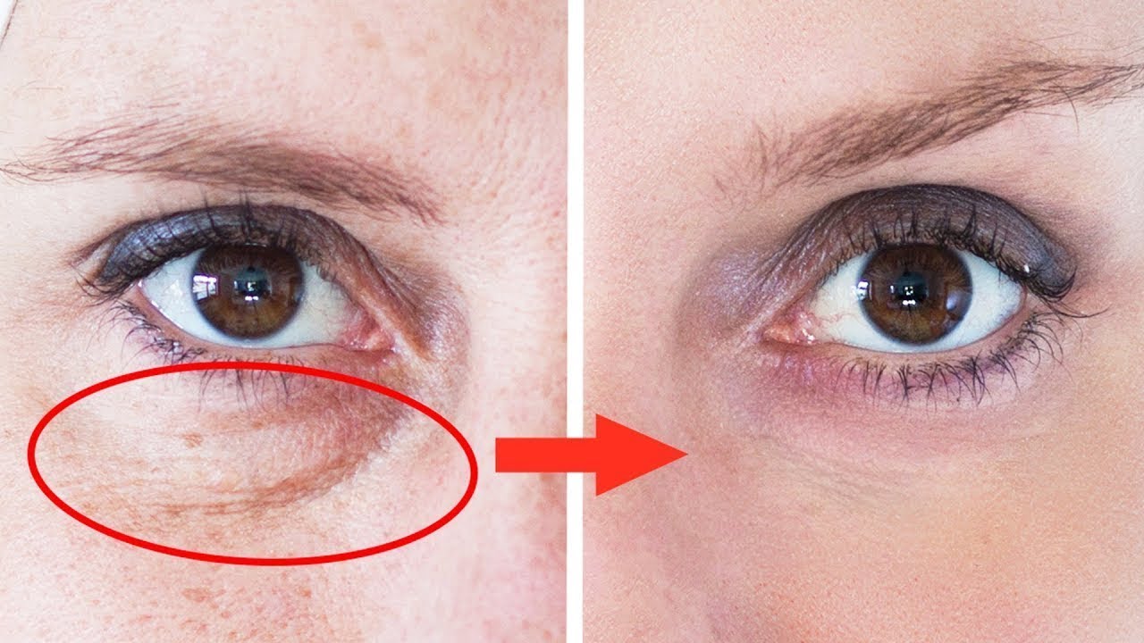 Se débarrasser des cernes facilement, c'est possible ?