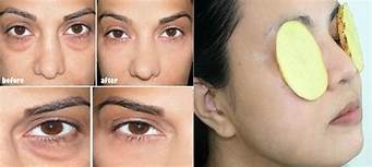 Comment se débarrasser des cernes Se débarrasser des cernes facilement, c'est possible ?