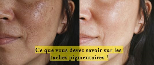 Ce que vous devez savoir sur les taches pigmentaires !