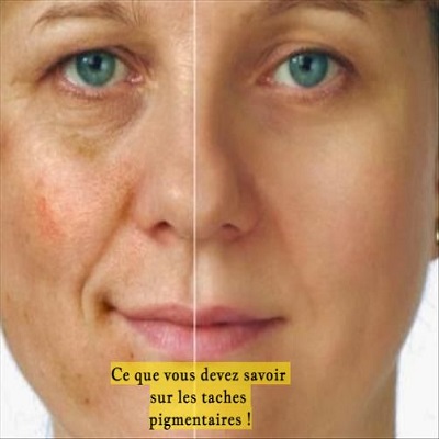 Ce que vous devez savoir sur les taches pigmentaires !