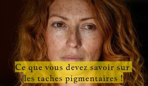 Ce que vous devez savoir sur les taches pigmentaires !
