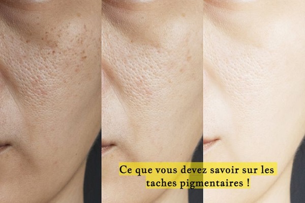 Ce que vous devez savoir sur les taches pigmentaires !
