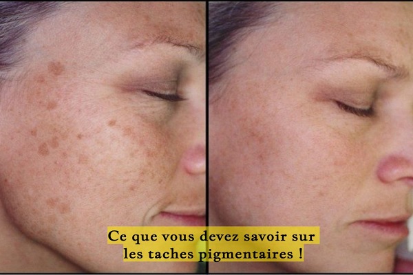 Ce que vous devez savoir sur les taches pigmentaires !