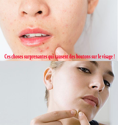 Ces choses surprenantes qui causent des boutons sur le visage ! Ces choses surprenantes qui causent des boutons sur le visage !