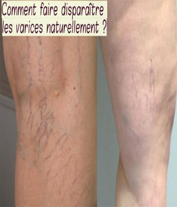 Enfin, voici un remède efficace contre les varices 