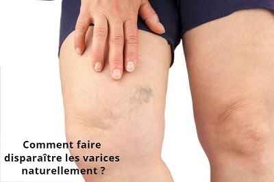 Comment faire disparaître les varices naturellement ?