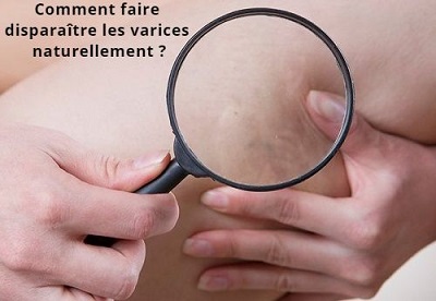 Comment faire disparaître les varices naturellement ?