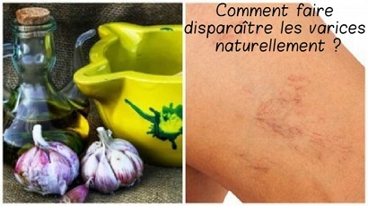 Comment faire disparaître les varices naturellement ?