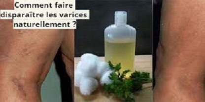 Comment faire disparaître les varices naturellement ?